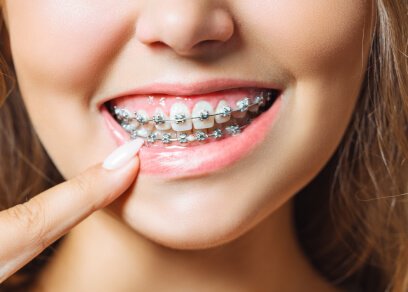 Braces