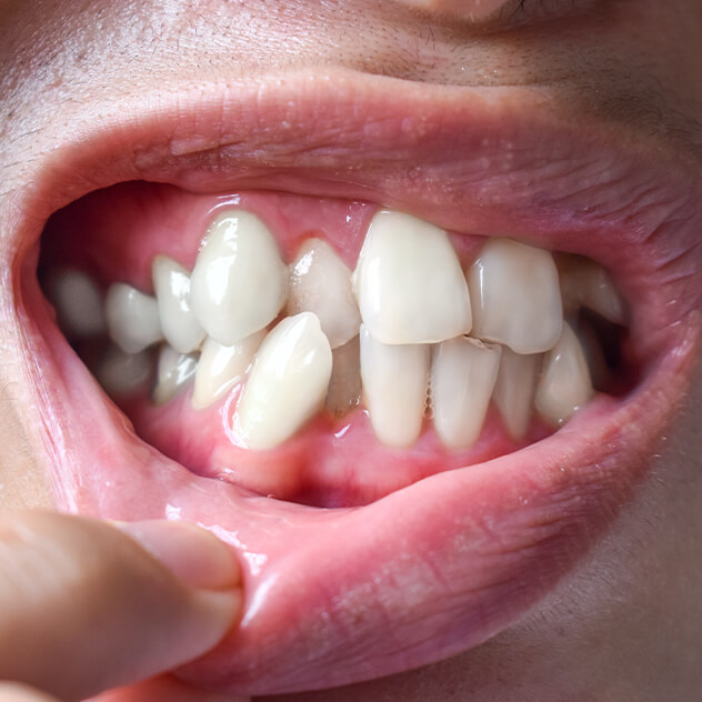 Who might need jaw surgery? 