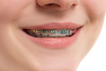 Types of braces