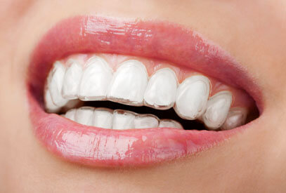 Clear Aligners